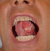 Ne passez pas à côté du prochain cancer buccal: Revue des lésions potentiellement malignes et du cancer de la bouche