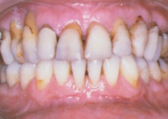 La nouvelle classification des conditions et maladies parodontales et péri-implantaires : quoi de neuf? Quoi de plus?
