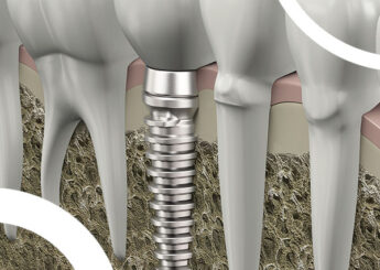Régénération osseuse guidée et ostéo-immunologie en chirurgie osseuse pré et péri-implantaire. Comment traiter efficacement et rapidement des défauts osseux de grandes étendues.