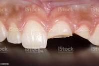 La gestion des fractures dentaires