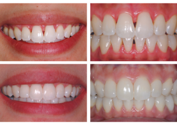 Moulage par injection pour restaurations monolithiques en composite avec la Méthode Bioclear