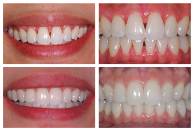 Moulage par injection pour restaurations monolithiques en composite ...