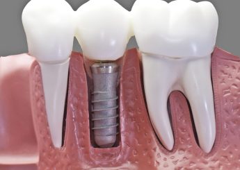 Implants in restorative dentistry important treatment (Conférence en anglais)