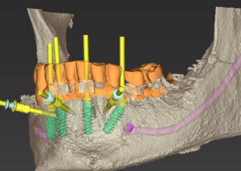 La prosthodontie à l'ère du numérique