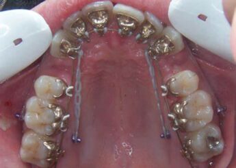 Orthodontie et chirurgie: trouver l’équilibre entre l’esthétique et l’occlusion à l’ère du numérique (En ligne)